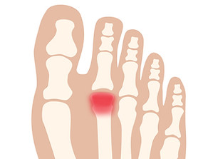 中足骨骨端症／フライバーグ病・第2ケーラー病