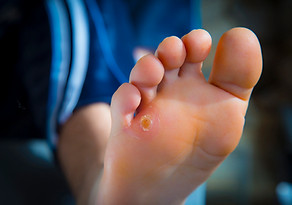 ウオノメ・胼胝