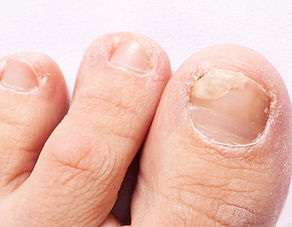 白癬・爪白癬