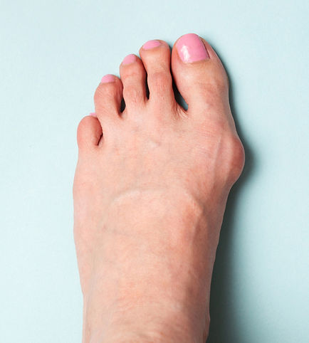 外反母趾イメージ