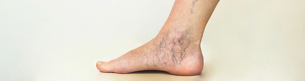 疲れやすい足の病気