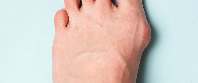 外反母趾イメージ