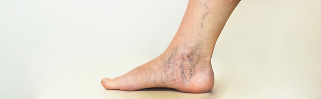 疲れやすい足の病気